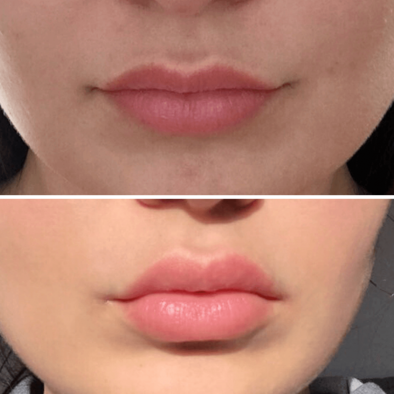 botox lip flip cost