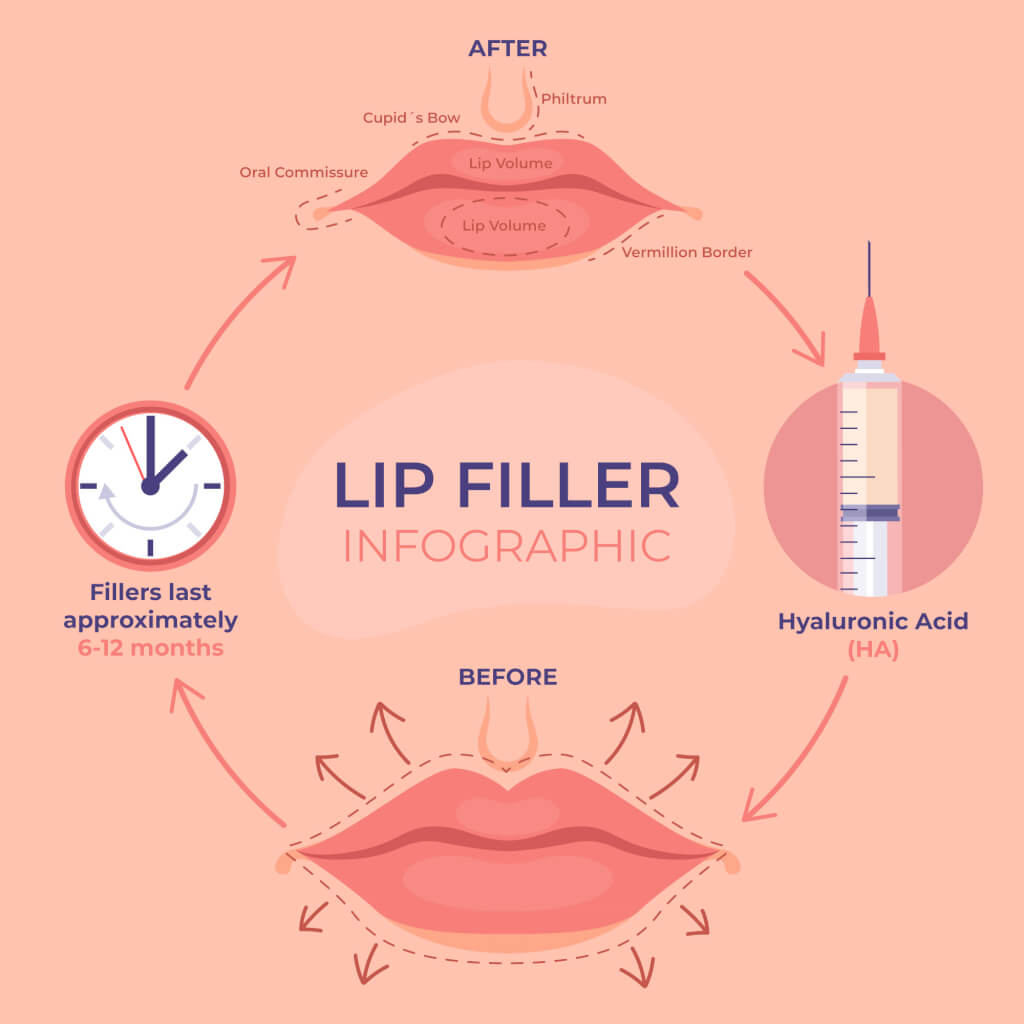 Lip Filler Swelling Stages Here