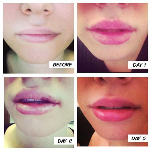 lip filler swelling stages