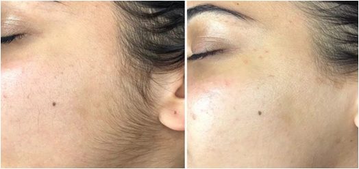 dermaplane before and after