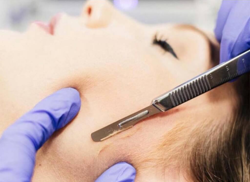 what is dermaplane