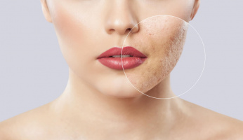 Acne Mapping: Acne Placements, What It Means and How To Treat It!