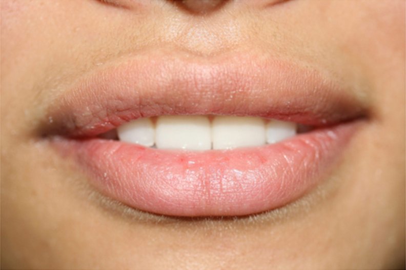 what is botox lip flip